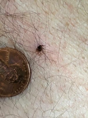 A deer tick embedded for about a day on the back of a local gardener. This is the nymph state but all stages can carry diseases. ANDREW MESSINGER