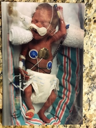 Hunter Fritz was born weighing less than two pounds