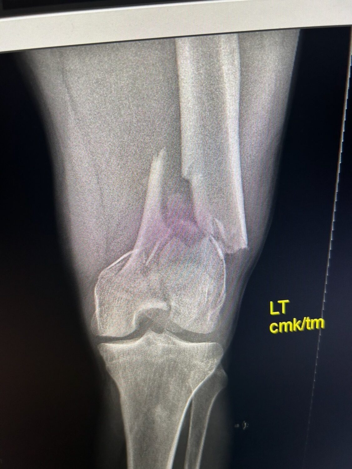 B.J. Walker's left leg was broken just above the knee when he was the victim of a hit-and-run driver in Bridgehampton in July. COURTESY B.J. WALKER